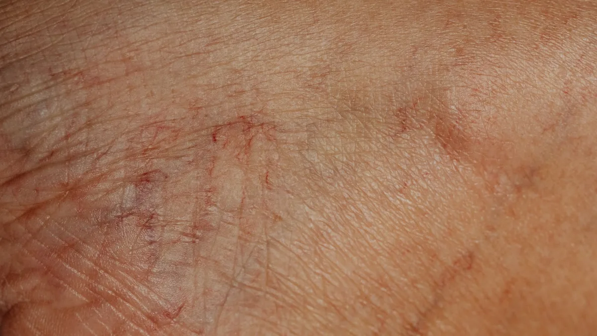 Melasma no corpo